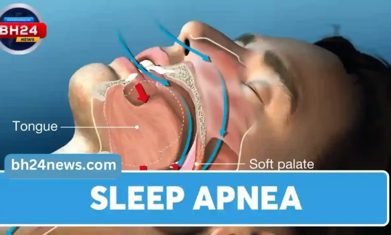 Sleep Apnea: