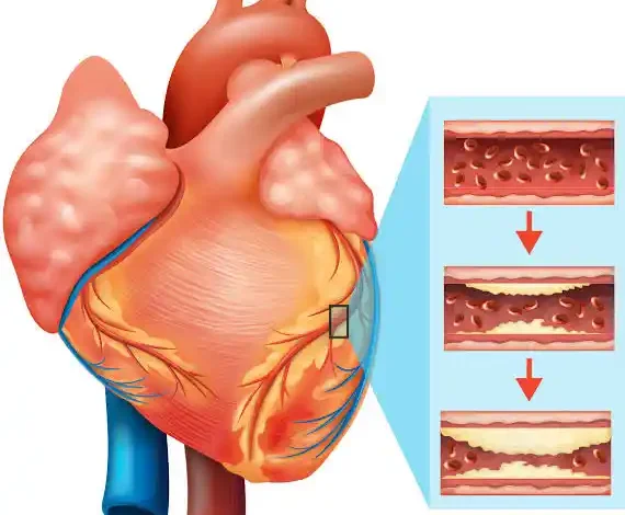 Heart Blockage Problem