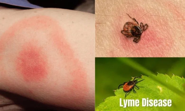 Lyme Disease