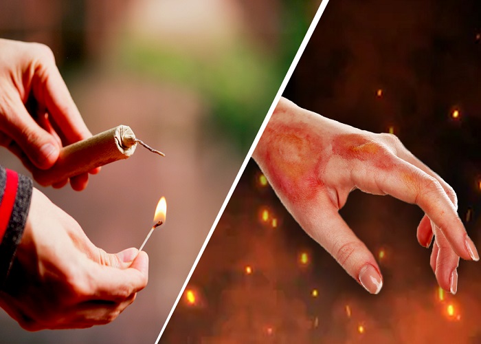 Patakhe Jal Jaane Par: दिवाली पर जलन होने पर करें ये घरेलू उपाय